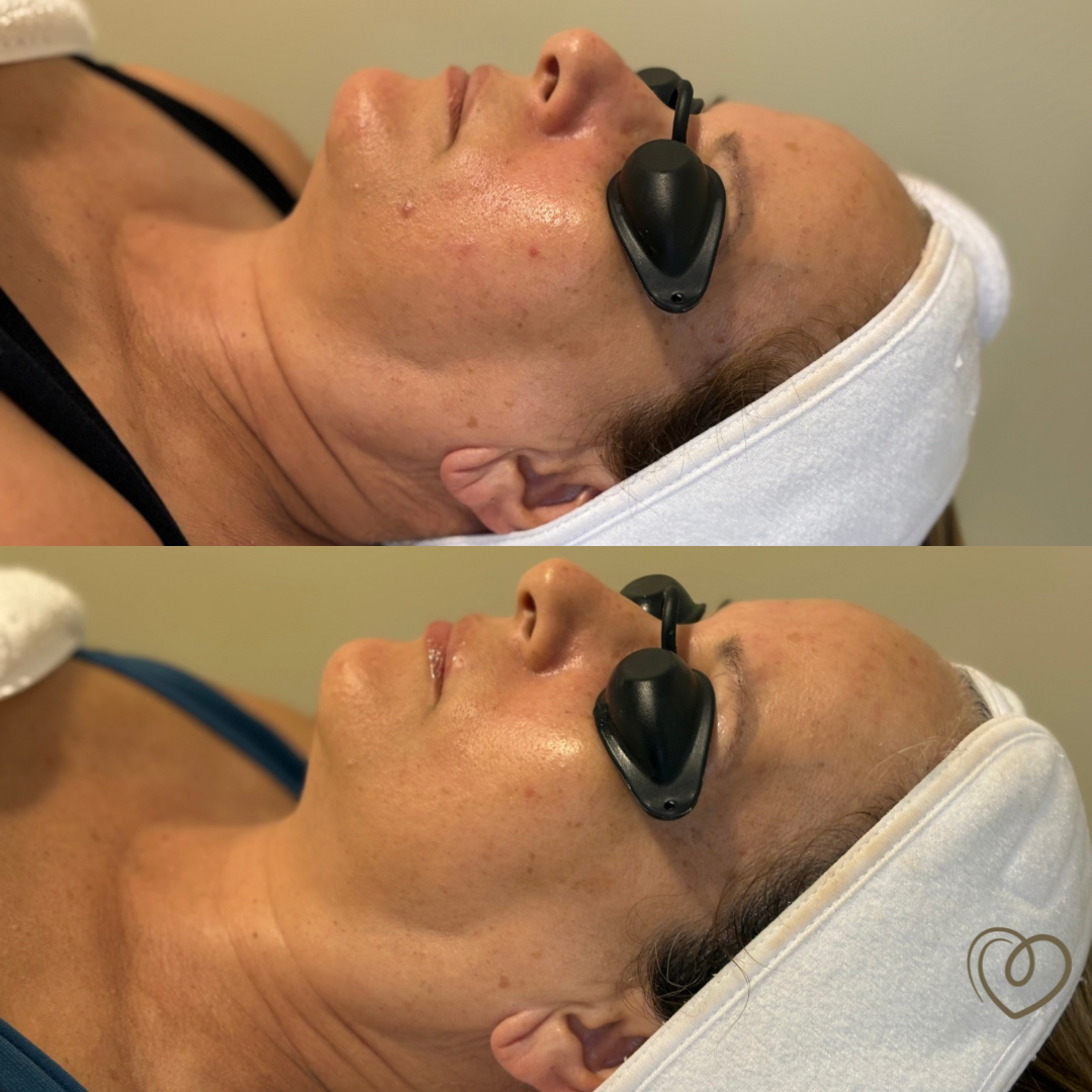Hifu Zona Facial